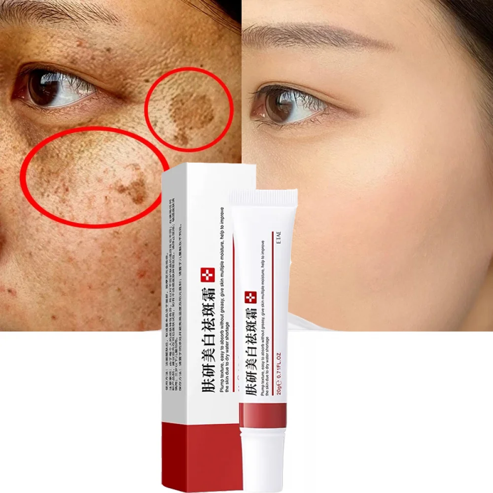 Effective Blemish Cream Pure Skin Anti Aging Freckles Moisturzing Acne Pimple Scar Dark Spots Removal Care Whitening | Красота и