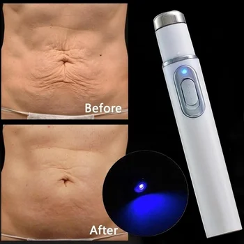 

1pc Medical Blue Light Therapy Laser Pen Varicose Veins Treatment Soft Scar Wrinkle Removal Treatment Scar Acne Just 7 Days