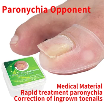 

Silicone Ingrown Toenail Correction Tool Invisible Ingrown Toe Nail Treatment Elastic Straightening Clip Brace Pedicure Tool 2pc