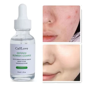 

30ml Salicylic Acid Solution Face Serum Acne Treatment Face Essence Shrink Pores Serum Oil Control Close Mouth Smooth Skin Care