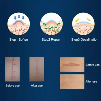 

Medical Scar Away Patch Silicone Gel Sheet Wound Marks Treatment Skin Removal Keloid Scars Cesarean Therapy Hypertrophic Se K0T9