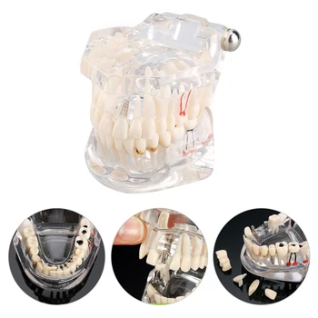 

1pc Teaching Study Tool For Medical Science Dental Disease Dental Implant Disease Teeth Model With Restoration Bridge Tooth