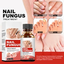 

Hand Foot and Nail Repair Liquid Special Care for Onychomycosis Nourishing Repair Liquid Moisturizing and Smoothing Nail Polish