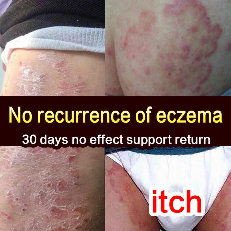 Натуральный травяной крем от зуда мазь китайский уход за кожей эффективный