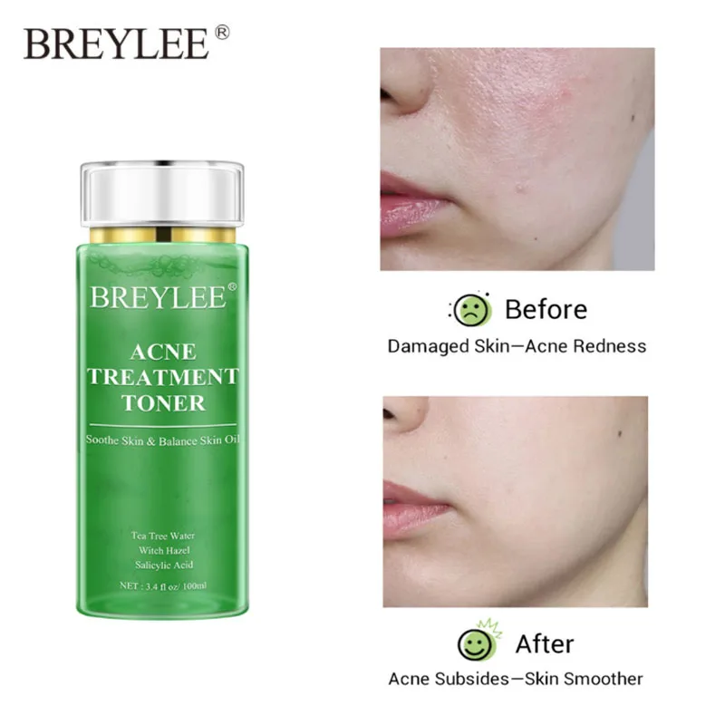 

BREYLEE Acne Treatment Toner Pimple Soothing Relieve Acnes Oil-Control Shrink Pores Acne Scar Removal Tea Tree Face Serum 100ml