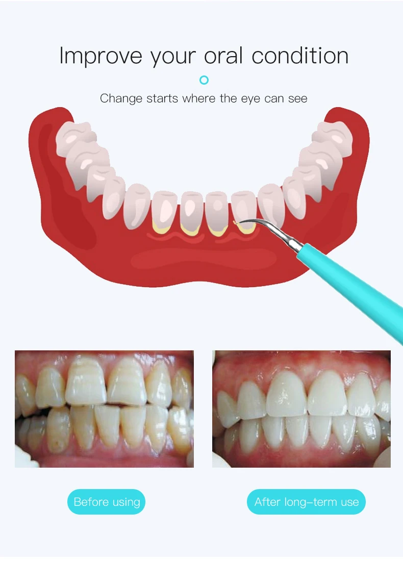 洁牙器2-拷贝_16