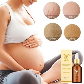 

Stretch Marks Removal Essential Oils Pure Natural Stretch Marks Remover Obesity Postpartum Anti-wrinkle Repair Cream Skin Care