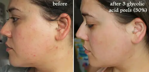 glycolic acid good for acne scars