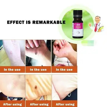 

10ML Genital Wart Treatment Papillomas Removal Of Warts Wart Removal Tags Remover Skin Against From Liquid Moles Liuld Remo G3X6