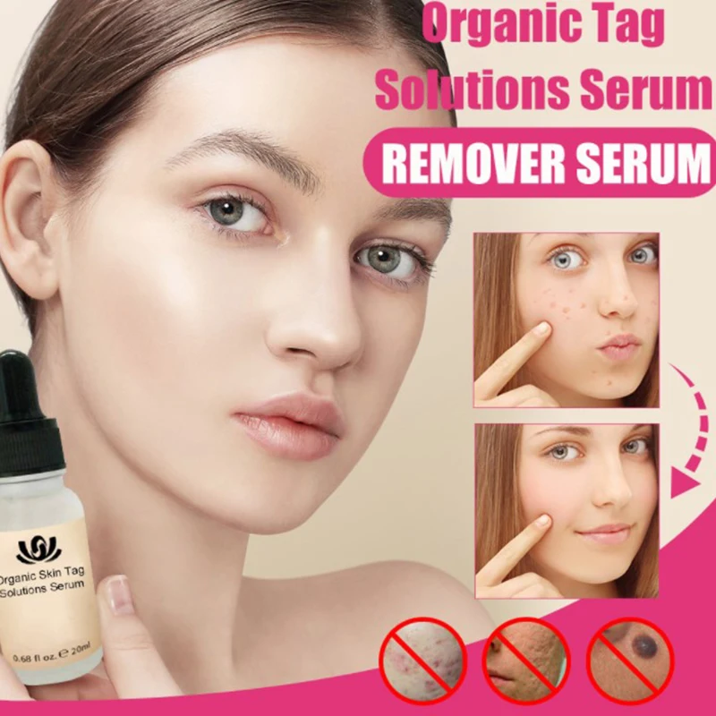 Organic Tags Solutions Serum Painless Mole Skin Dark Spot Remover Face Wart Tag Freckle Removal Cream Oil Plaster | Красота и