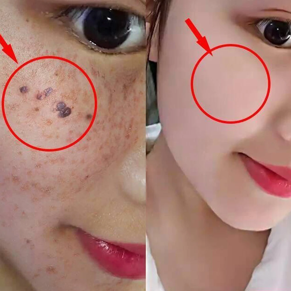 20 мл раствор для восстановления моль и кожи безболезненный моль для кожи темное пятно для восстановления лица бородавок веснушки Восстанавливающий Крем Масло D086