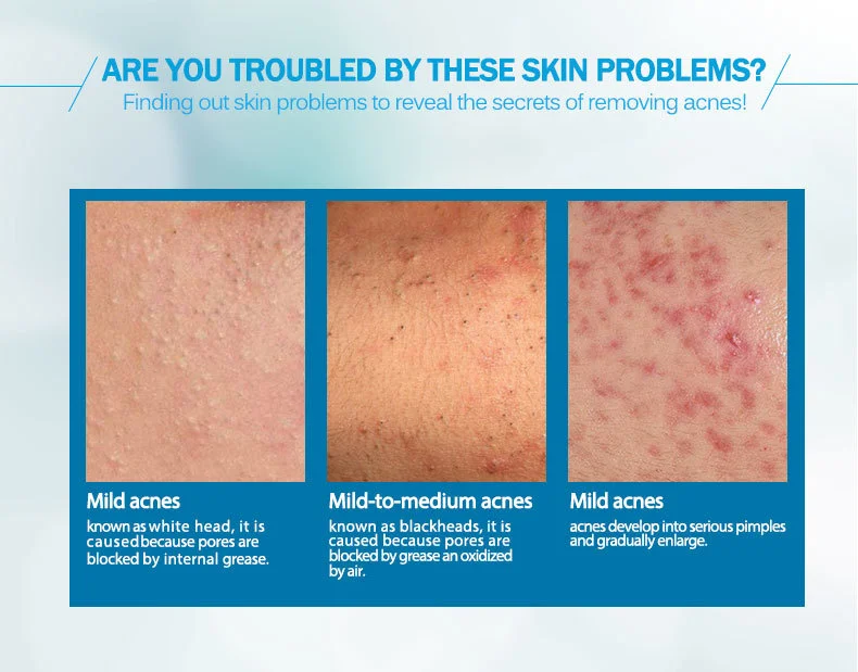 anti-acne_05