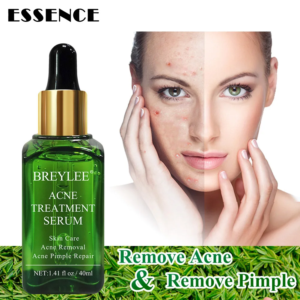 

Best Anti Acne Removal Essence Remover Pimple Repair Shrink Pores Face Skin Care 40ml QQ99