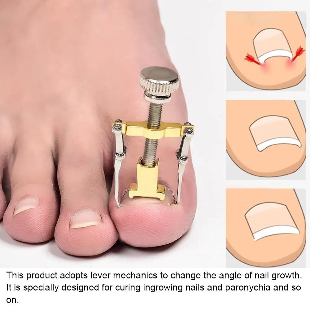 2pcs Ingrown Toe Nail Fixer Pedicure Toenail Recover Nail Correction Tool Nail Corrector Tool Toenail Fixer Foot Care