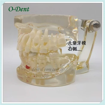 

Dental Children Pathological Teeth Model Dentist Orthodontic Model Oral Hygiene Demonstration Tooth Study Teaching for kids