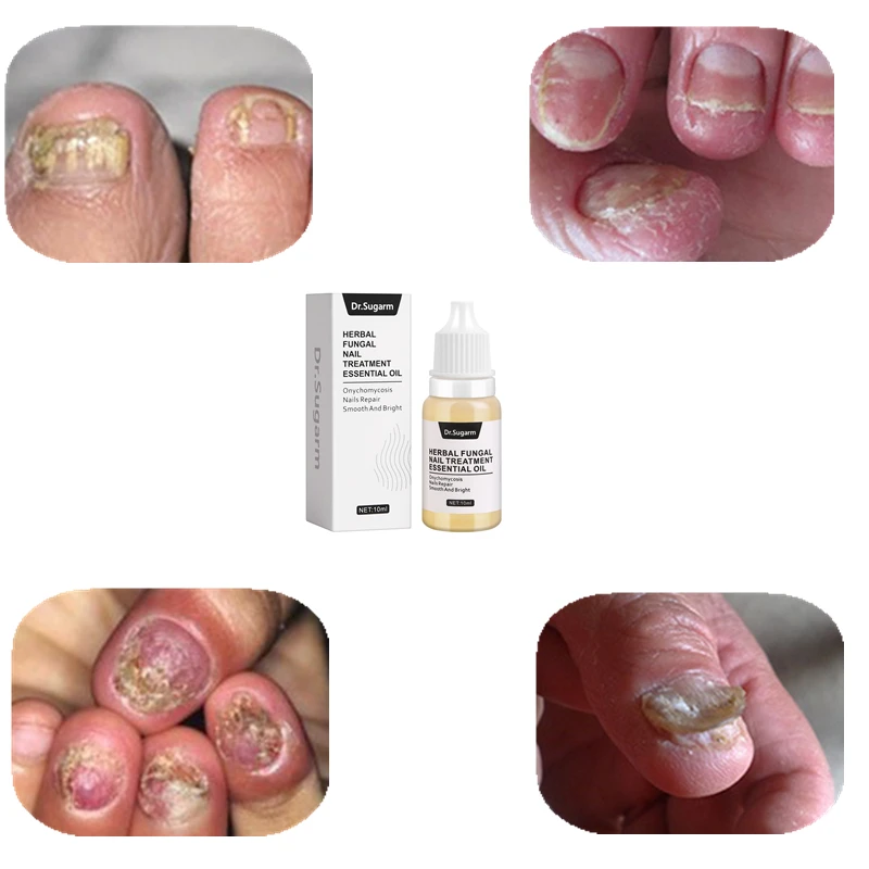 Dr Sugarm Fungal Nail Treatment Feet Care Essence Herb Antibacterial Onychomycosis Paronychia Anti Infection Toe Nail 4