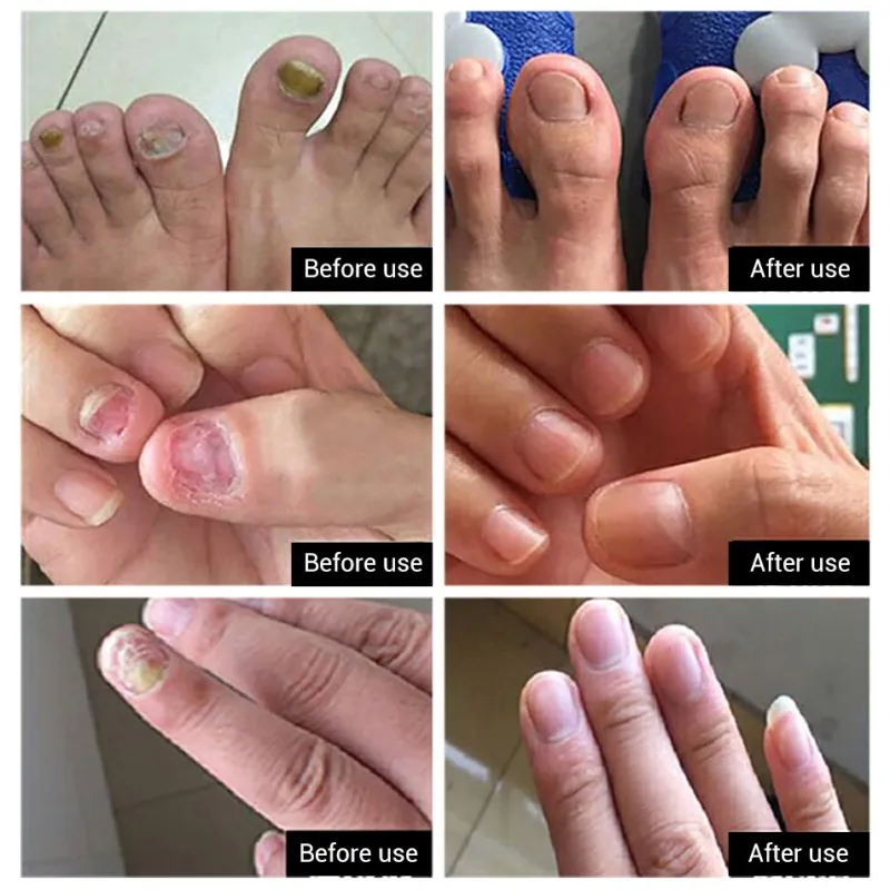 Грибковый Лечение ногтей мощное удаление грибка анти-инфекция Paronychia Onychomycosis Восстановление сыворотки