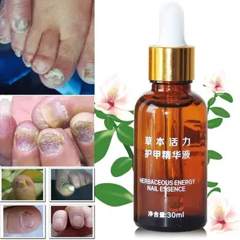 

Fungal Nail Treatment Feet Care Essence Nail Foot Whitening Infection Onychomycosis Fungus Anti Paronychia Removal Gel Nail S0S6