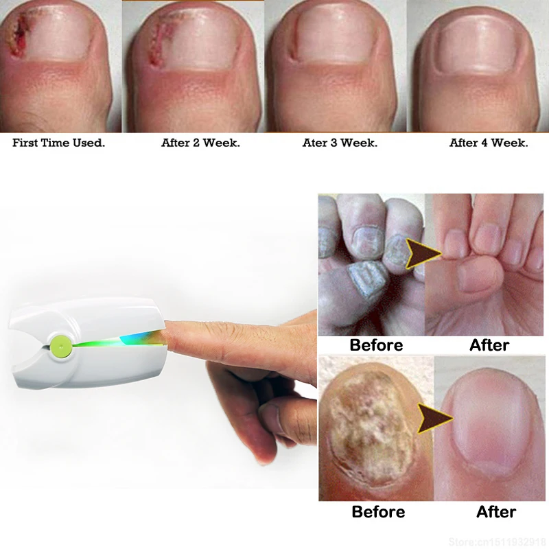Stop Nail Fungus Infection Cold Laser Therapy Toenail Fungus Treatment Nail Onychomycosis Paronychia Cure Yellow Nail Rehabilitation Physiotherapy Aliexpress