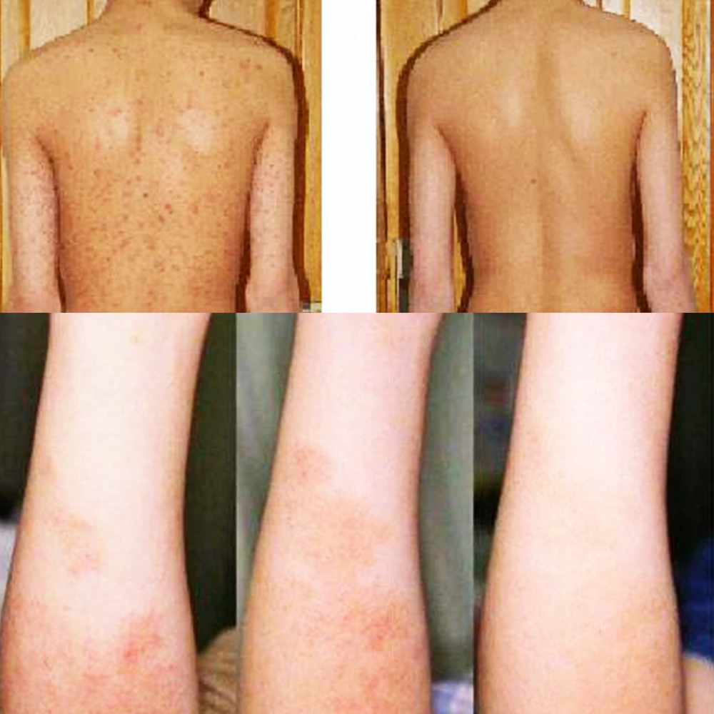 Китайский травяной Топический антипригарный крем для кожи Обезболивающий