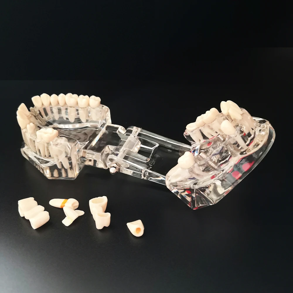 Nowy Model dentystyczny Implant zębów przywrócenie mostu nauczanie studium medycyna nauka choroba dentysta stomatologia produkty 2 Nowy Model dentystyczny Implant zębów przywrócenie mostu nauczanie studium medycyna nauka choroba dentysta stomatologia produkty 2