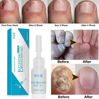 

10ml Nail Care Solution To Gray Nail Medicine Biofilm Finger Foot Foot Care Antibacterial Liquid Toe Armor Gray Scrub P1N7