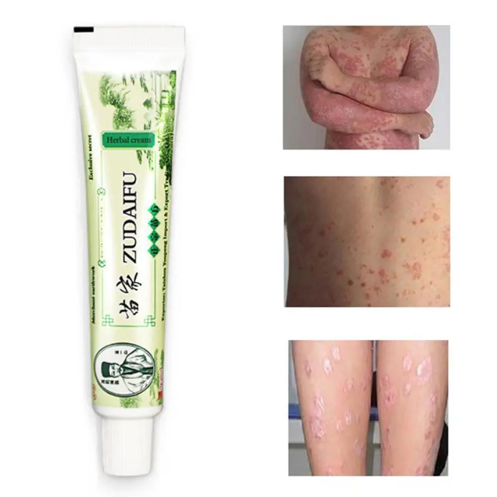 Zudaifu Eczema крем от псориаза дерматит эцематоид Pruritus лечение мазь крем от псориаза китайский медицинский