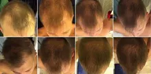 Cuidado del cabello para el crecimiento del cabello aceites esenciales esencia Original auténtico 100% pérdida de cabello líquido salud belleza suero denso para el crecimiento del cabello