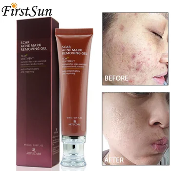 

ARTISCARE ginseng extract against black dots cream scar removal facial blackhead acne skin care treatment bleaching cream 30ml
