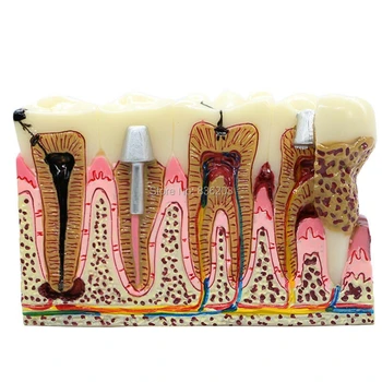 

Human Dental Caries Anatomy dentist Tooth Model traumatic pistol medical skeleton trauma Male member medical instruments