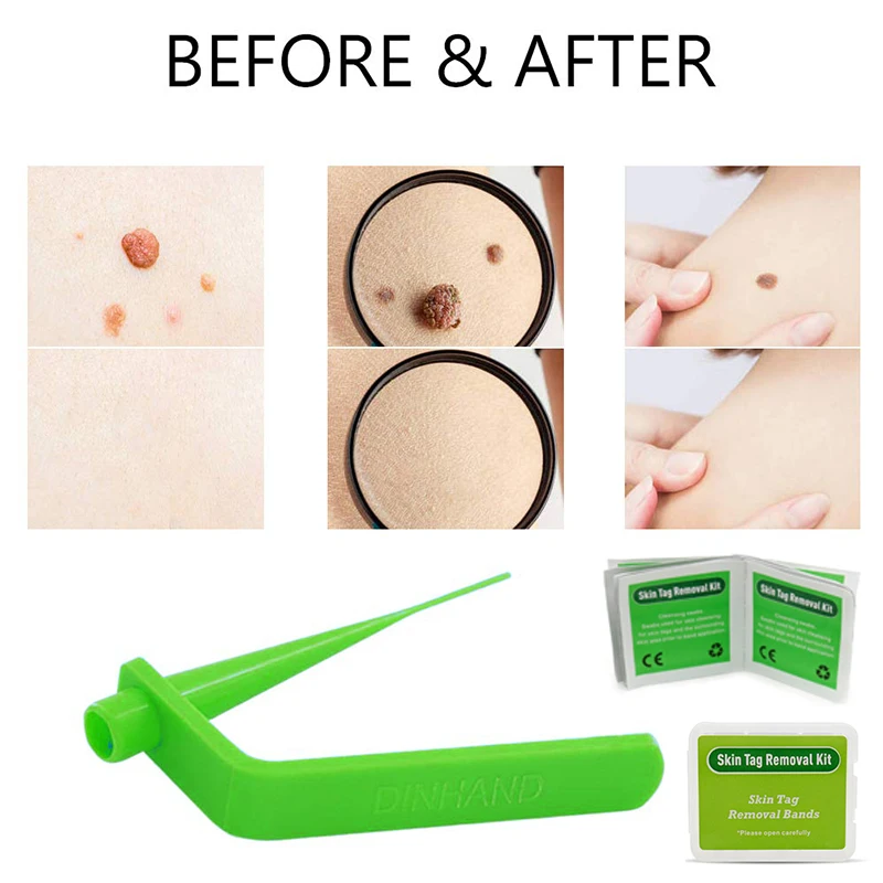 Новая медицинская бирка для удаления родинок и бородавок микро этикетка набор