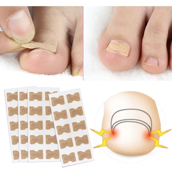 

10Pcs/Sets Foot Toenail Patch Ingrown Toe Nail Correction Sticker Glue-Free Foot Care Stickers Repair Paronychia Tool Foot Care