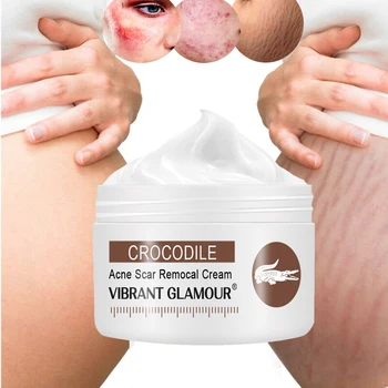 

Removal of acne stretch marks pregnancy repair cream facial scar skin care