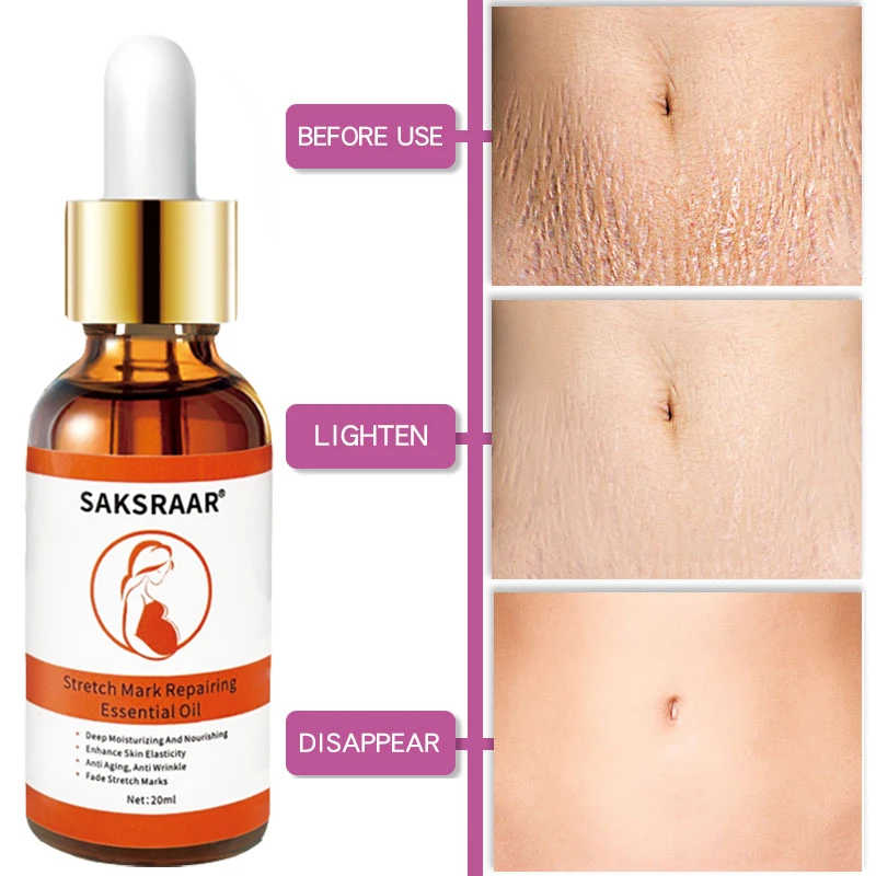 stretch marks removal oil