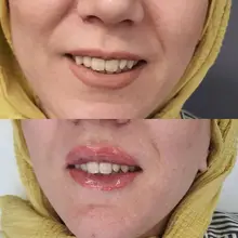 Jeringa de llenado de ácido hialurónico labial, Derm Sub fino profundo de 1ml/2ml/5ml, con aguja