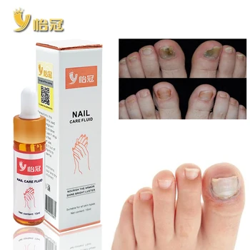 

Effective Antibacterial Gray Nails Treatments Essential Oil Nail Fungus Art Repair Tools Foot Nail Care Improve Infection 15ML