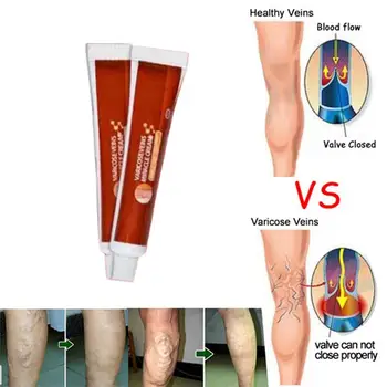 

1Pcs 20g Varicose Veins Ointment Varicosity Angiitis Vasculitis Cream Phlebitis Medical Removal Plaster Spider I7G0