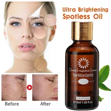 Темные пятна удаляют ультра осветляющее масло эфирные масла отбеливающие эфирные масла сжигающие растяжимые пятна удаление шрамов осветление