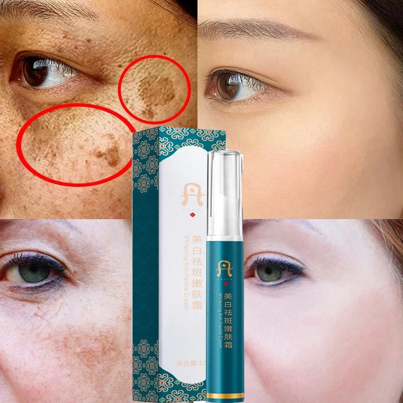 Effective Whitening Freckle Cream Remove Melasma Acne Spot Pigment