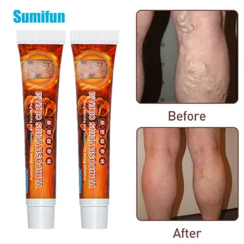 

Sumifun Varicose Veins Treatment Ointment Vasculitis Phlebitis Spider Medical Plaster Varicosity Angiitis Cream Skin Health Care