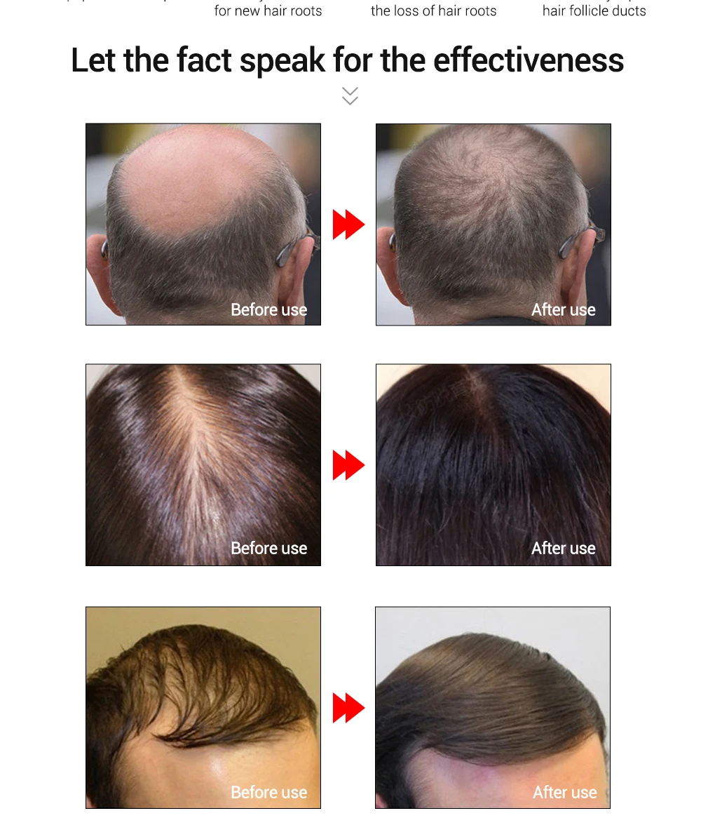 LANBENA спрей для роста волос эссенция масло Предотвращение против товары выпадения волос продукты питают легко носить Уход за волосами