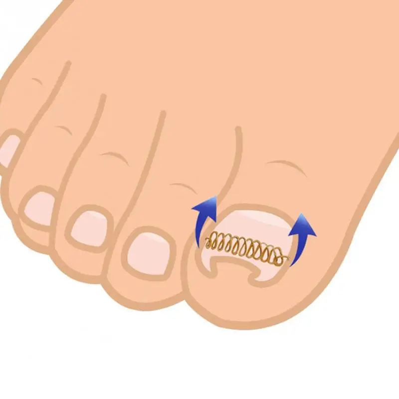 

12pcs/set Wire Fixer Professional Straightening Toenail Corrector Acronyx Stainless Steel Ingrown Pedicure Clip Home Painless