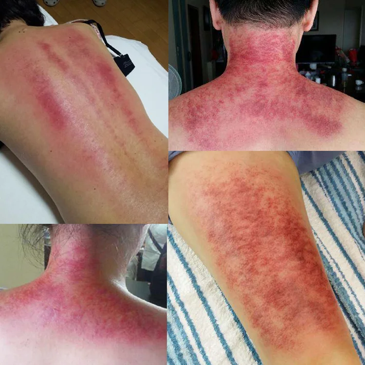 RIGHTBEST iastm 5 шт. в наборе Бесплатная доставка набор инструментов из нержавеющей