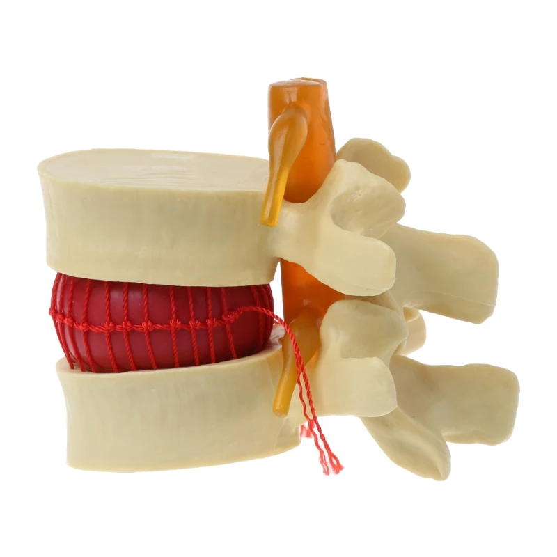 

Anatomical Spine Lumbar Disc Herniation Anatomy for Medical Teaching Tool
