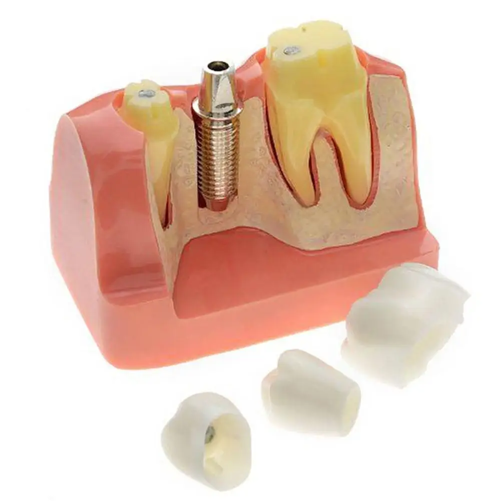 

Professional Dental Teeth Model Transparent Pathological Implant Nerve Model For Medical Science Dental Disease Teaching Study