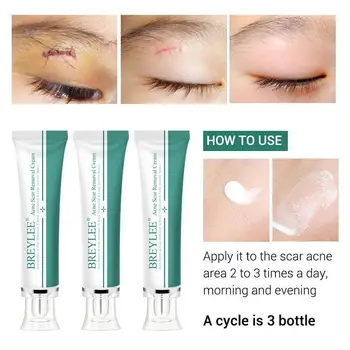 

Acne Scar Removal Gel Fade Acne Marks Spots Remove New Essence Pigmentation Treatment Skin Soothing Acne Prevent Serum S7E8