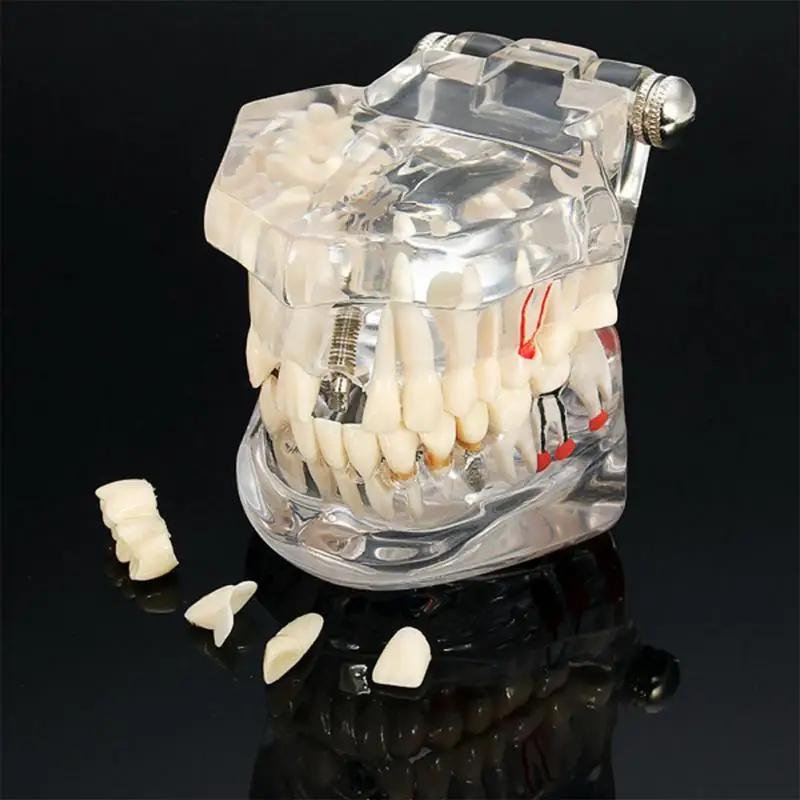 Oral Care Teeth Model Dental Implant Disease Study Teaching With Restoration &ampBridge Tooth |