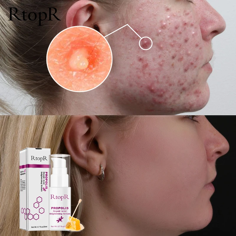 RtopR Propolis Repair Acne Brightening Serum Acne Scar Spots Cleaning Serum Shrink Pores Eliminates Acne Treatment Oil control