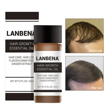 

Fast Hair Growth Ginger Essential Oil TCM Effective Extract Anti Hair Loss Treatment Regrowth Nourish Hair Care For Men women