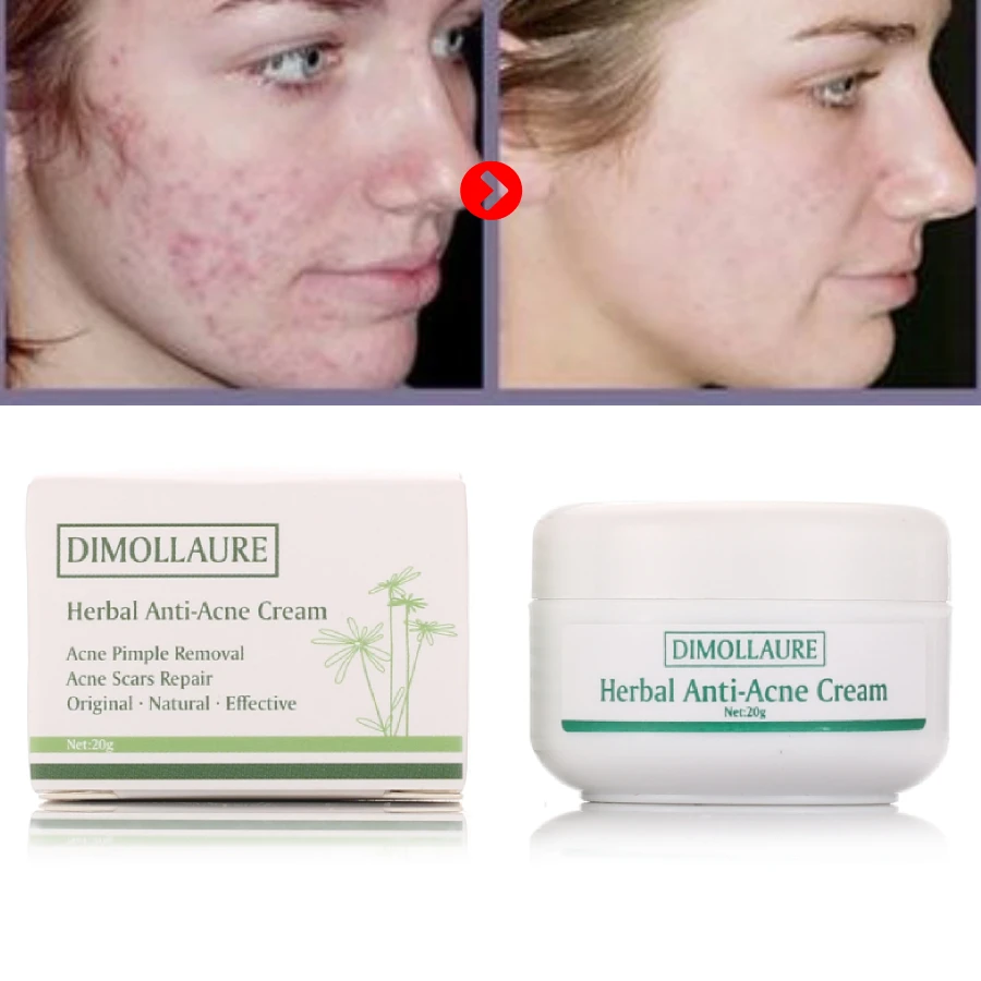 

Dimollaure Anti-acne cream Face cream acne treatment Comedone Pimple Acne Scar Blackhead Removal Oil control Skin care whitening